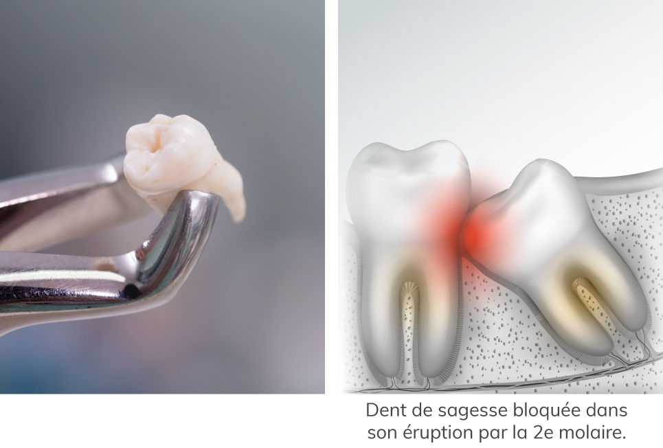 Extraction des dents de sagesse à Montluçon - Dentiste Montluçon